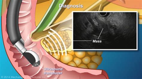 The sound waves emitted from the ultrasound transducer yield detailed ...