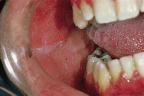 Oral Viral Infections - Dental Clinics