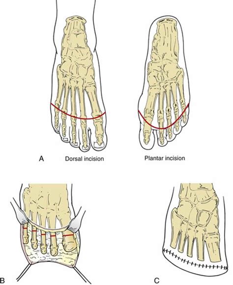 Amputation causes, types of amputation and amputation complications