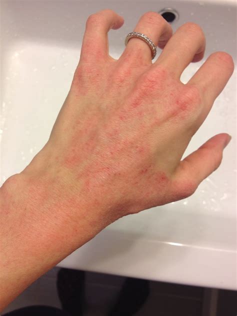 My journey with itchy skin.: Flare (mini-flare)? + pictures