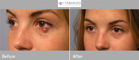 Chalazion Removal