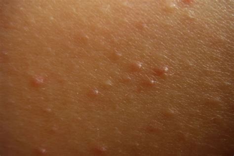 How To Treat Keratosis Pilaris On Arms And Legs at marygbrown blog