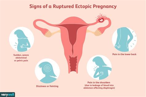Ectopic Pregnancy - Santripty also called a tubal pregnancy