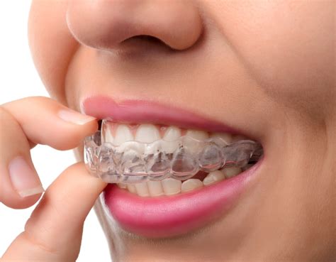 Services-invisalign-braces | On Broadway Dentistry