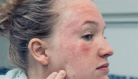 Eczema on Face: Symptoms, Causes, Types & Treatment