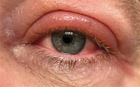 Severe Allergic Reaction Eye Swelling
