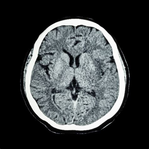 CT Scan Of Brain : Show Normal Human 's Brain ( CAT Scan ) Stock Photo ...