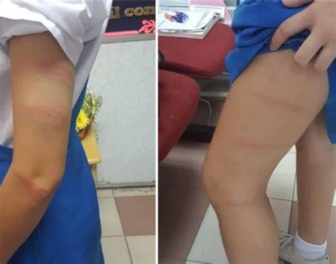 Schoolgirl left with bruises after being caned by teacher