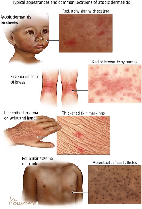 Atopic Dermatitis | Atopic dermatitis, Dermatology nurse, Dermatology