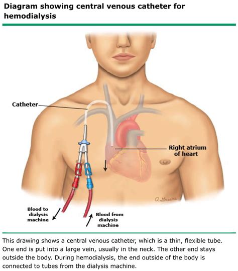 Tunneled Central Venous Catheter Placement Images And Photos Finder ...