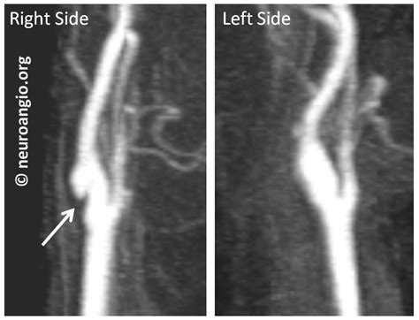 Index of /wp-content/uploads/Archives/Venous_Epidural_MMA_Fistula