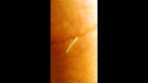 [REQUESTED] Worm? Fiber? Morgellons? Exiting the Skin (Thumb) Parasite ...