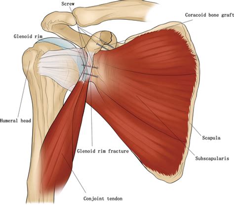 Treatment of Chronic Anterior Shoulder Dislocation by Coracoid ...