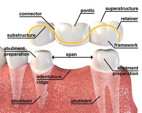 Parts Of Fixed Partial Denture
