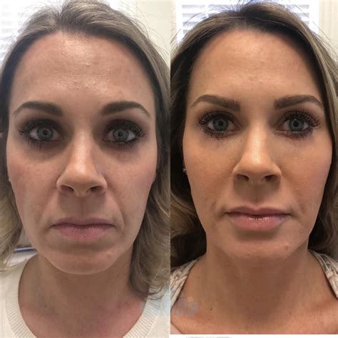 Juvéderm® & Restylane® Before and After Photo Gallery | Charlotte, NC | Dilworth Facial Plastic ...