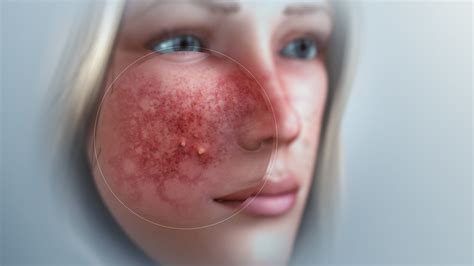 Rosacea: Types, Causes, and Treatment - Scientific Animations