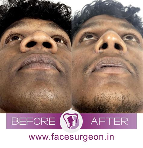 Nose Bridge Surgery for A Depressed Nasal Bridge – Richardson's Plastic Surgery Hospitals