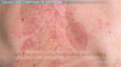 What Is Erythema? - Definition, Symptoms & Causes - Video & Lesson ...