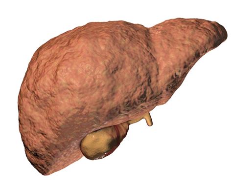 What You Need to Know About Hepatic Fibrosis - Fatty Liver Disease