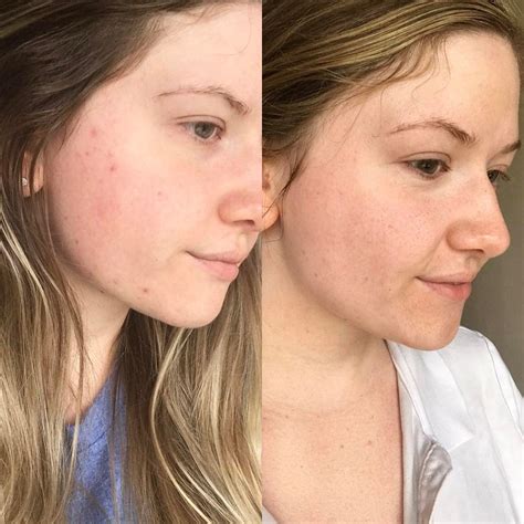 "My results after 2 weeks with my custom @curology formula. So far so good!" @jeskaabeautyxo ...