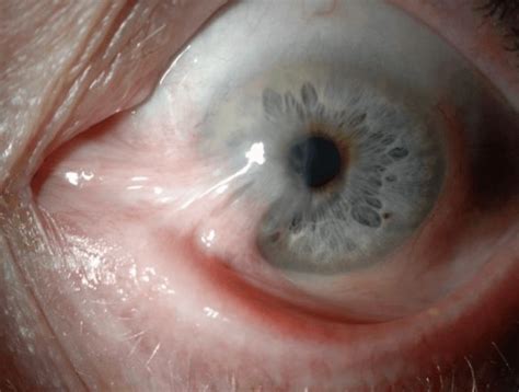 Pterygium Eye Disease