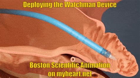 Watchman Device – Explained and FAQ’s Answered by a Cardiologist • MyHeart