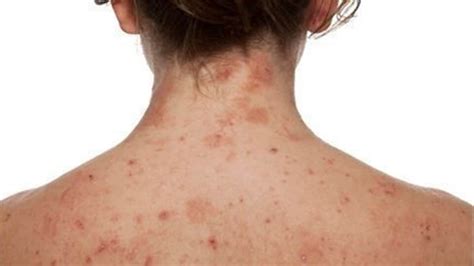 How skin diseases form differently across the body: Study | Health ...