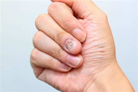 Types Of Fingernail Fungus Pictures - Design Talk