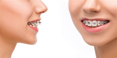 Can Invisalign Fix Overbite And Crooked Teeth - TeethWalls