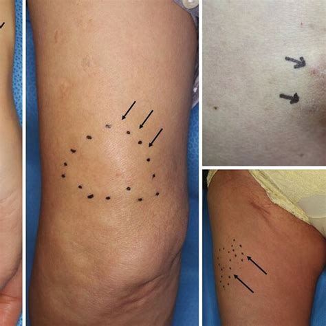 Clinical features of subcutaneous nodules involving the upper and lower ...