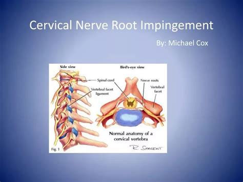 PPT - Cervical Nerve Root Impingement By: Michael Cox PowerPoint Presentation - ID:1366154