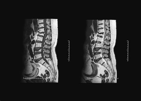 Mri Scan Of Lumbosacral Showing Lumbar Spondylosis And Compression Fracture At L1 And L2 ...