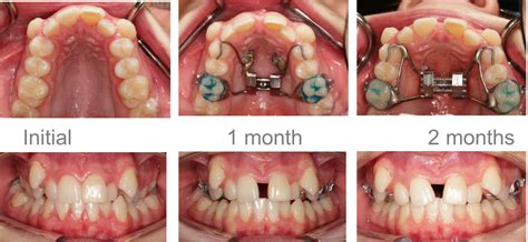 Palate Expander After Braces at Harry Ricks blog