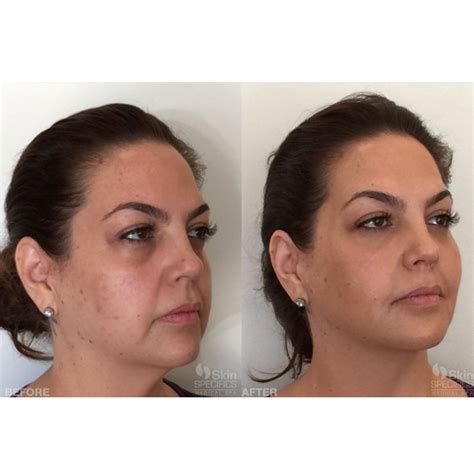 Juvederm Cheeks Before And After Photos