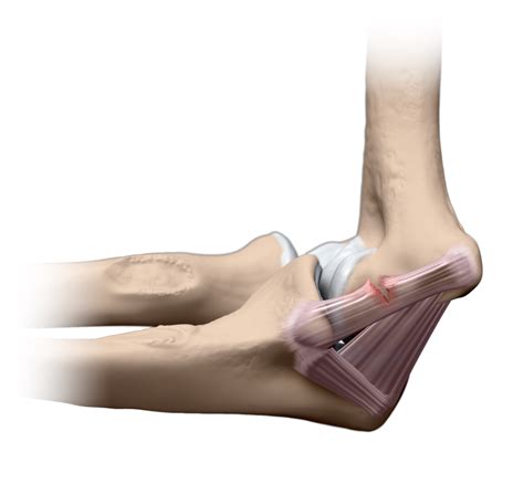 Arthrex - Ruptura do ligamento colateral ulnar