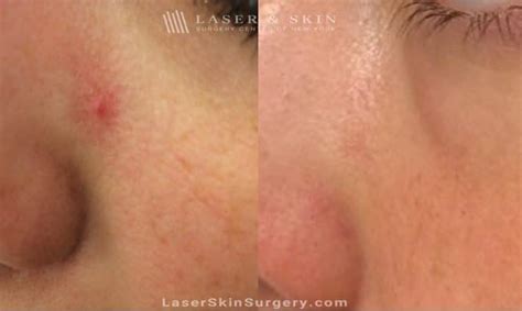 Facial Spider Veins - Laser NY