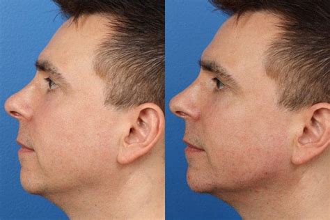 What are the best procedures for neck tightening in 2024? - Philip ...