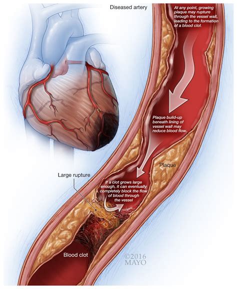 Cardiovascular Disease & Smoking | EX