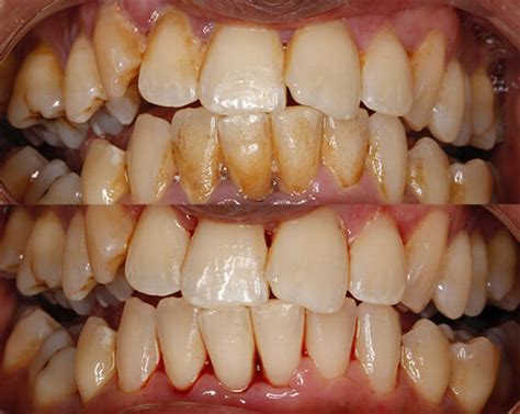 Dental Scaling and Root Planing in Iran | MITRAMED