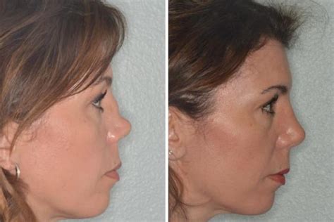 Revision Nose Job Rib Cartilage | Dr. Anthony Bared