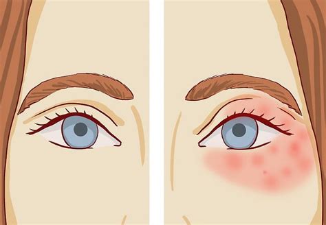 5 Home Remedies To Treat Dryness Around The Eyes