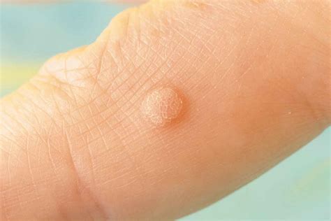 11 effective natural ways to get rid of irritating warts | Better Homes ...