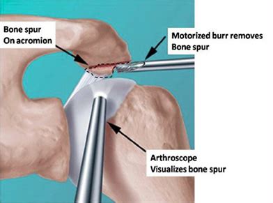 Subacromial decompression and bursectomy – NSPDD