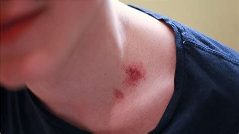 how to get rid of a hickey in 1 hour - how to give someone a hickey ...