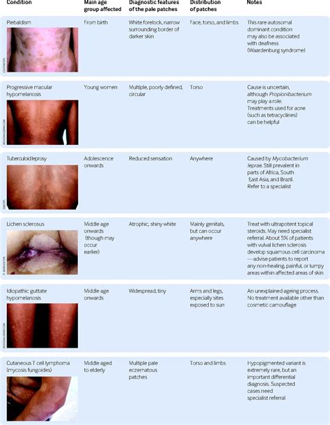 An approach to hypopigmentation | The BMJ