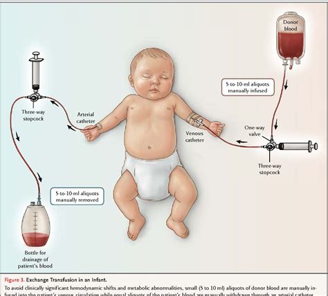 Figure 3 from Case records of the Massachusetts General Hospital. Case 6-2014. A 35-day-old boy ...