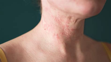 Eczema (Atopic Dermatitis) Complications | Everyday Health