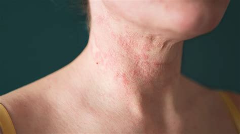 Eczema on the Face and Neck: Triggers and Treatment