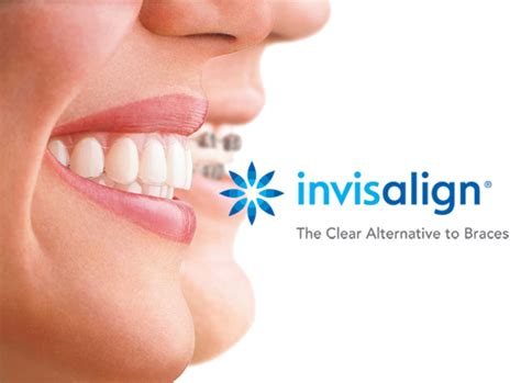 Invisalign Facts: 5 Cool Facts You Probably Didn’t Know about Invisalign