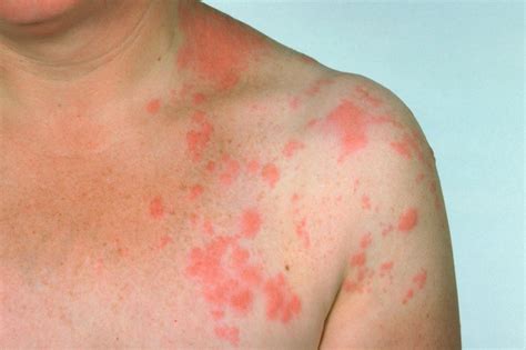 How Many Times Should You Get The Shingles Shot at Anthony Moore blog